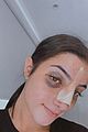 charli damelio shares new photos post nose surgery 02