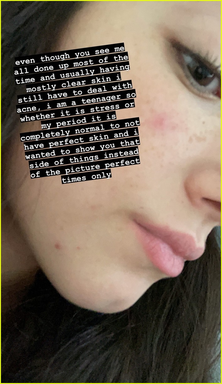 charli damelio opens up about acne i am a teenager 02