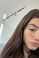 charli damelio opens up about acne i am a teenager 01