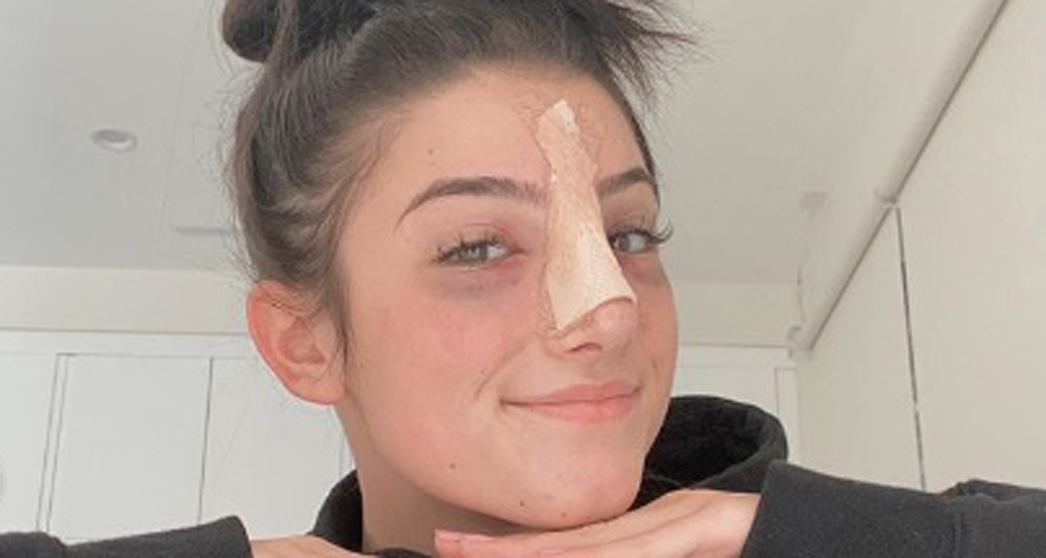 Charli D Amelio Nose Job Did Charli D Amelio Do Her N - vrogue.co
